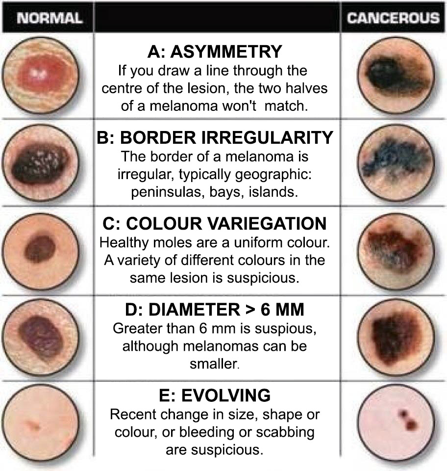 How Curable Is Melanoma Skin Cancer - CancerWalls